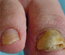 渗透软化疗法 3天轻松祛除灰指甲 抗复发