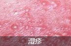 “分型灭菌免疫平衡疗法”立刻止痒 分型治各类瘙痒