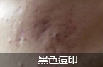 （中西医光学排毒疗法）分型完美祛痘印 不留疤痕