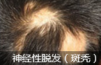 中西医生物综合疗法 彻底激活毛囊 恢复毛母细胞生发固