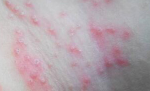 南京患了急性湿疹需要注意什么 