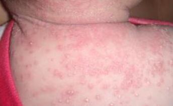 湿疹是怎么引起的？湿疹的图片-南京华肤皮炎所