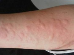 南京皮肤研究所官网_导致荨麻疹发病的原因