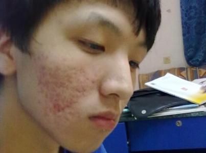什么东西有助于预防青春痘?南京市皮肤专科医院
