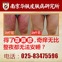 南京治疗荨麻疹的医院，大闸蟹吃出皮肤病来了