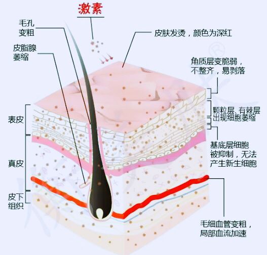 引发皮炎常见的因素有哪些