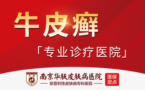 南京看牛皮癣哪家好